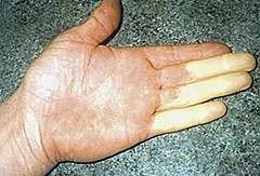 sindroma dedo branco